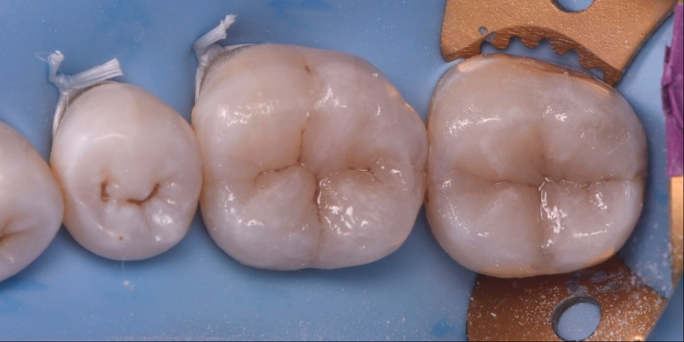 posterior-perfection-anterior-artistry