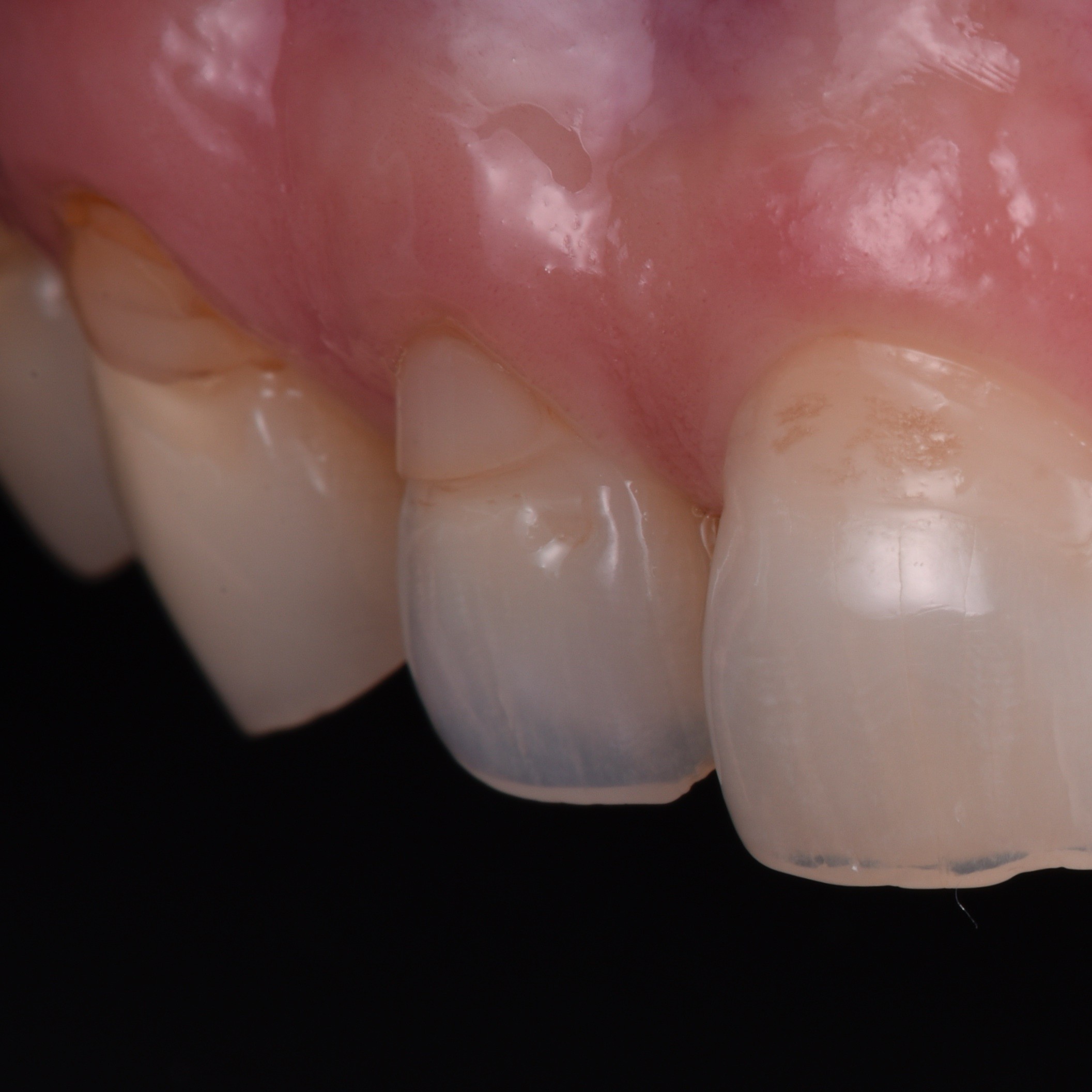 posterior-perfection-anterior-artistry